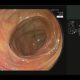 Fujifilm Cad Eye AI powered endoscopy