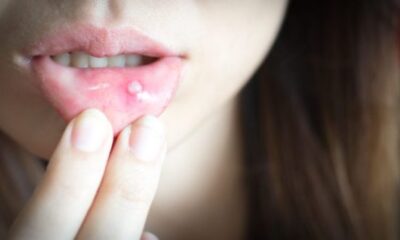 Mouth Ulcers