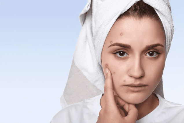 Top Tips on How to Cope with and Reduce Adult Acne