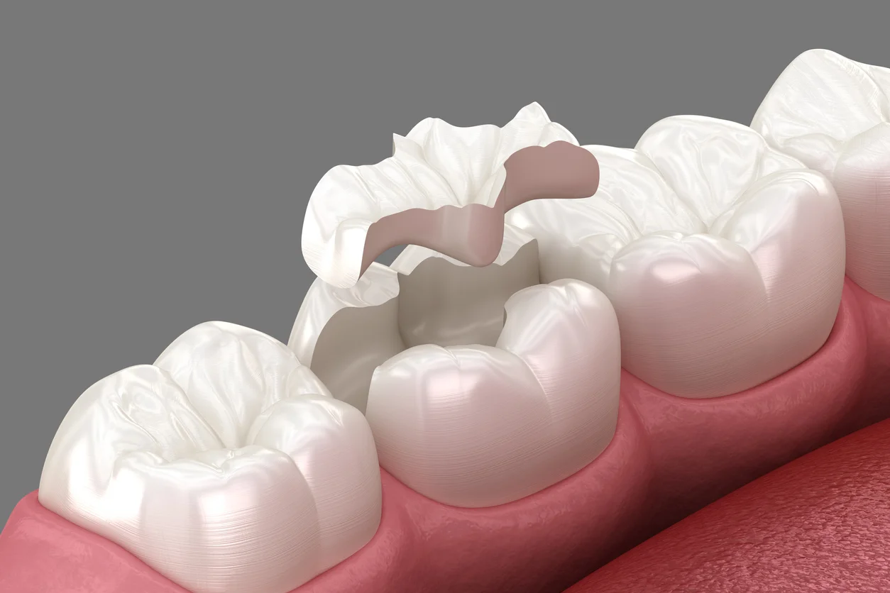 Rochdale Inlays and Onlays Reveal Their Power to Restor Smiles Precisely