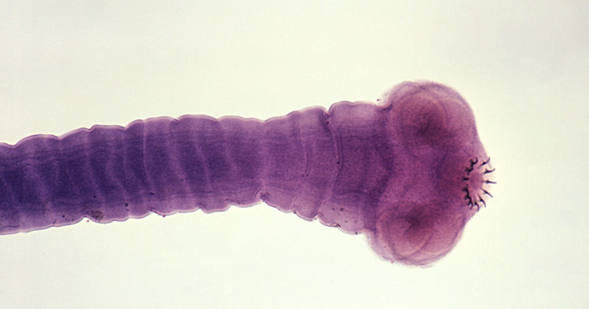 What to know about pork tapeworms in the brain, after RFK Jr. said he got a parasitic infection