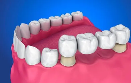 A Modern Solution for Dental Restoration