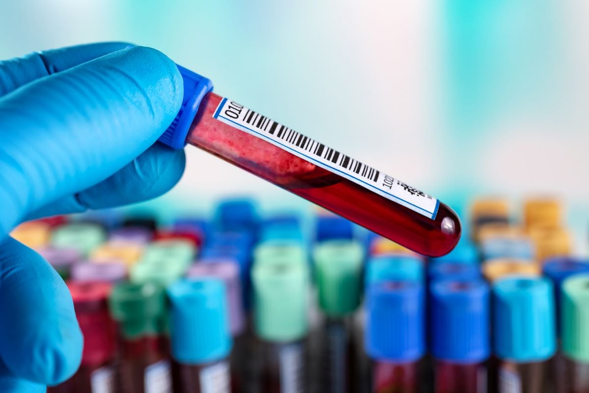 Blood Test Beats Doctors for Early Diagnosis of Alzheimer's Disease