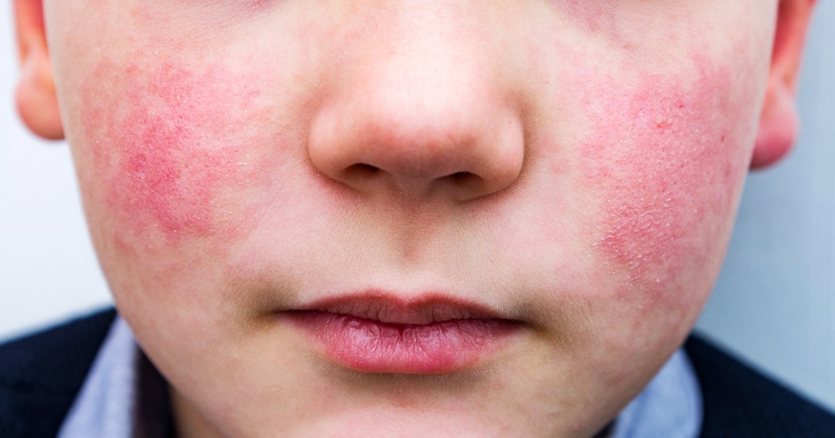 'Slapped cheek' rash-causing virus on the rise among kids, CDC warns