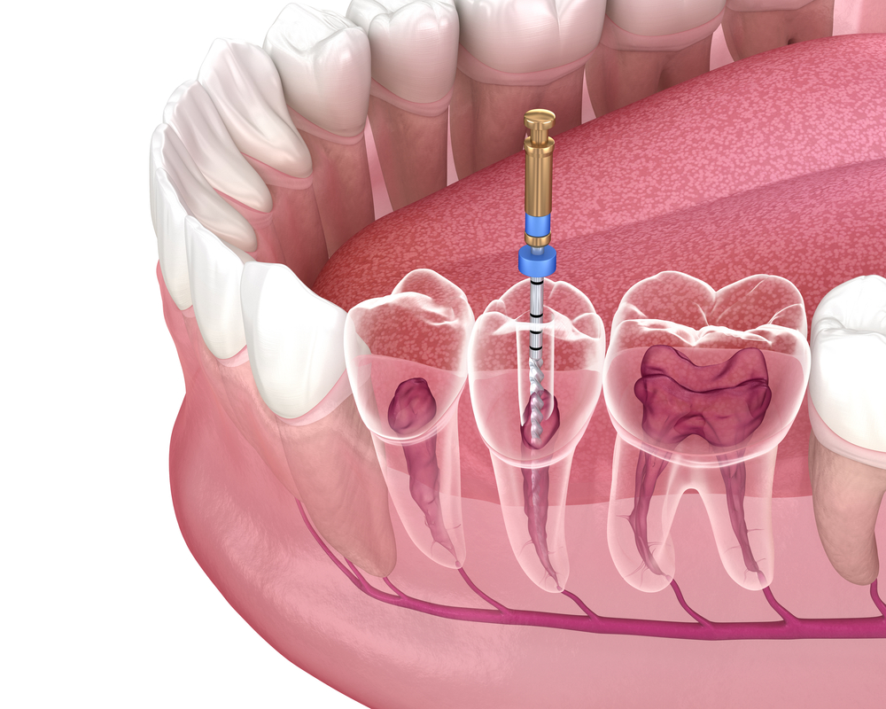 Dental implants Fall River