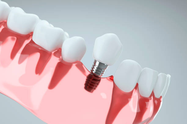 Dental Implants Fort Worth TX