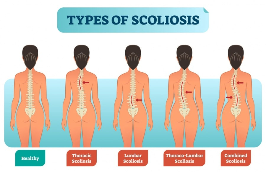 Expert Guide to Lumbar Scoliosis: Treatments, Symptoms