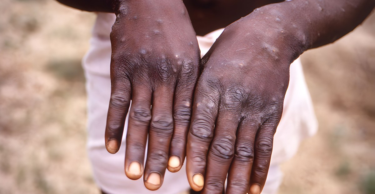 Monkeypox: WHO, Africa’s CDC declare mpox a public health emergency. Will it change anything?