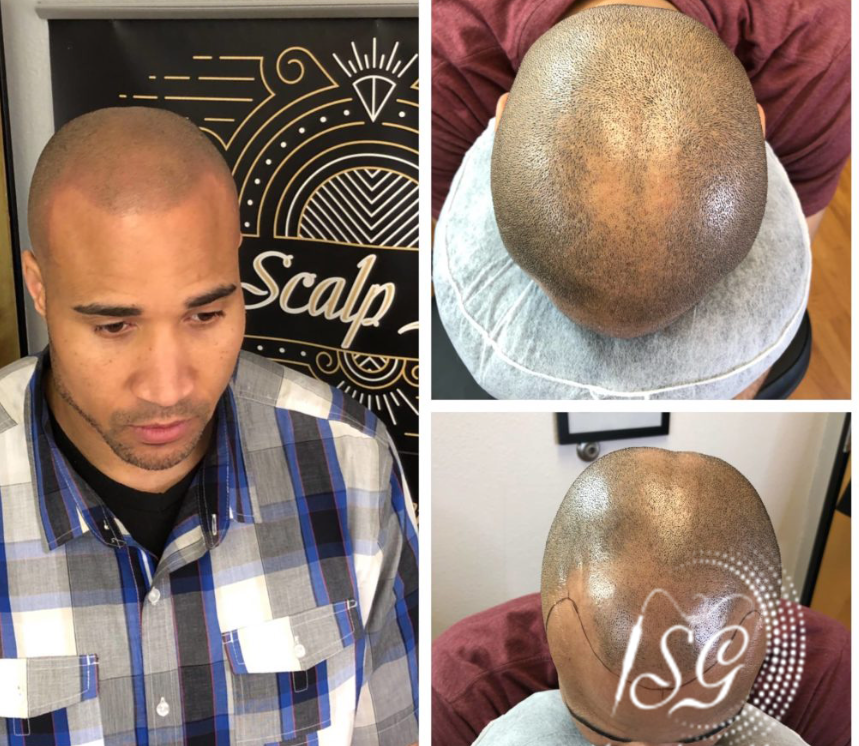 Restore Your Hair and Confidence with Scalp Micropigmentation in Austin