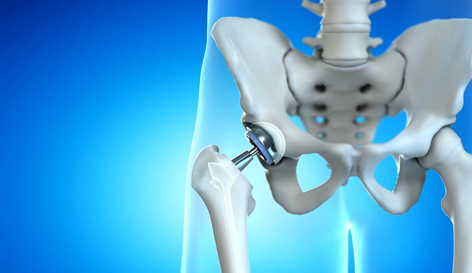 Understanding Right Hip Total Replacement: A Comprehensive Guide