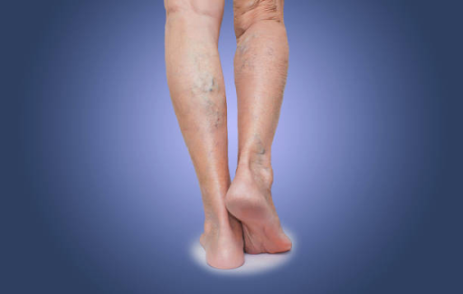 What You Need to Know About Varicose Vein Operation