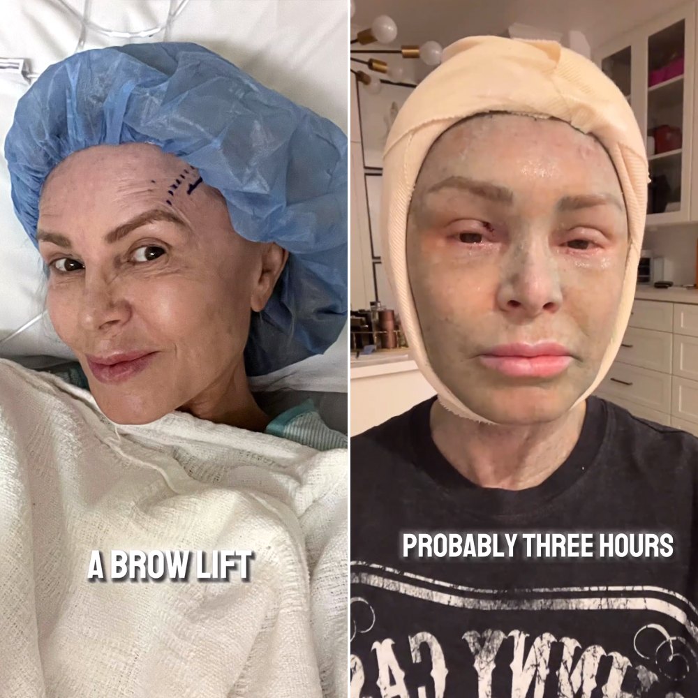 Tamra Judge Gets a Brow Lift