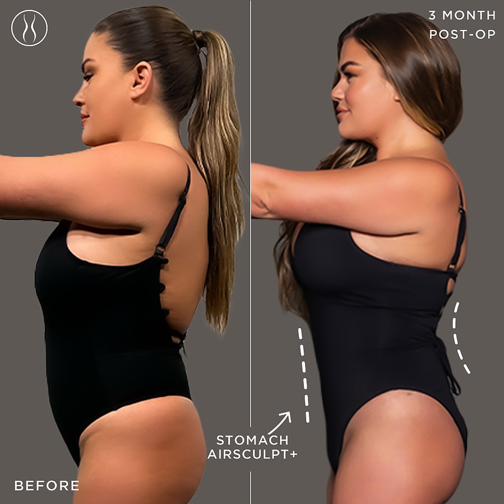 See Brittany Cartwrights Before and After AirSculpt Photos I Deserve to Feel Good