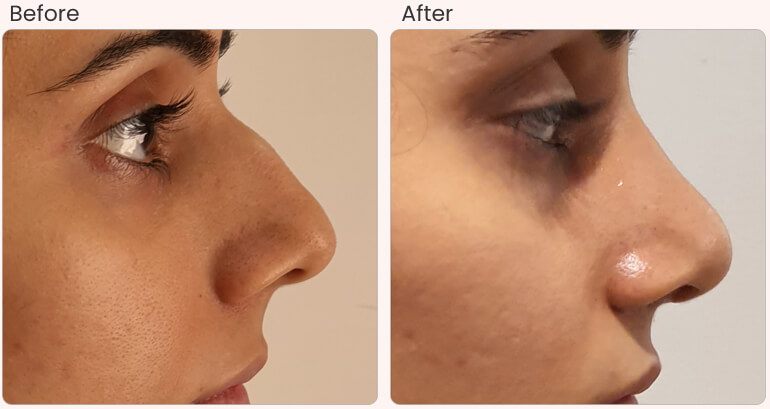 rhinoplasty surgery in Delhi