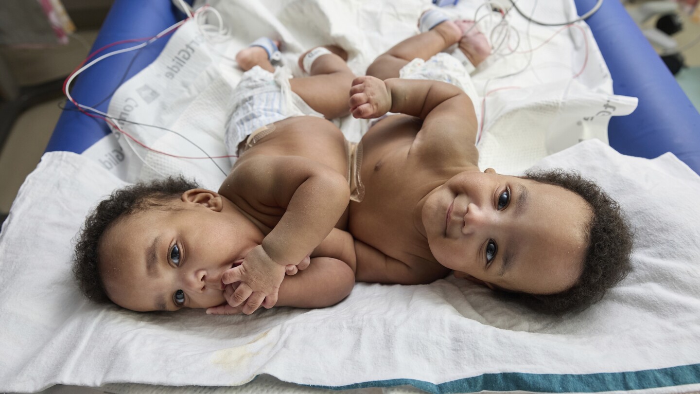 Twins born conjoined celebrate 1st birthday after separation surgery