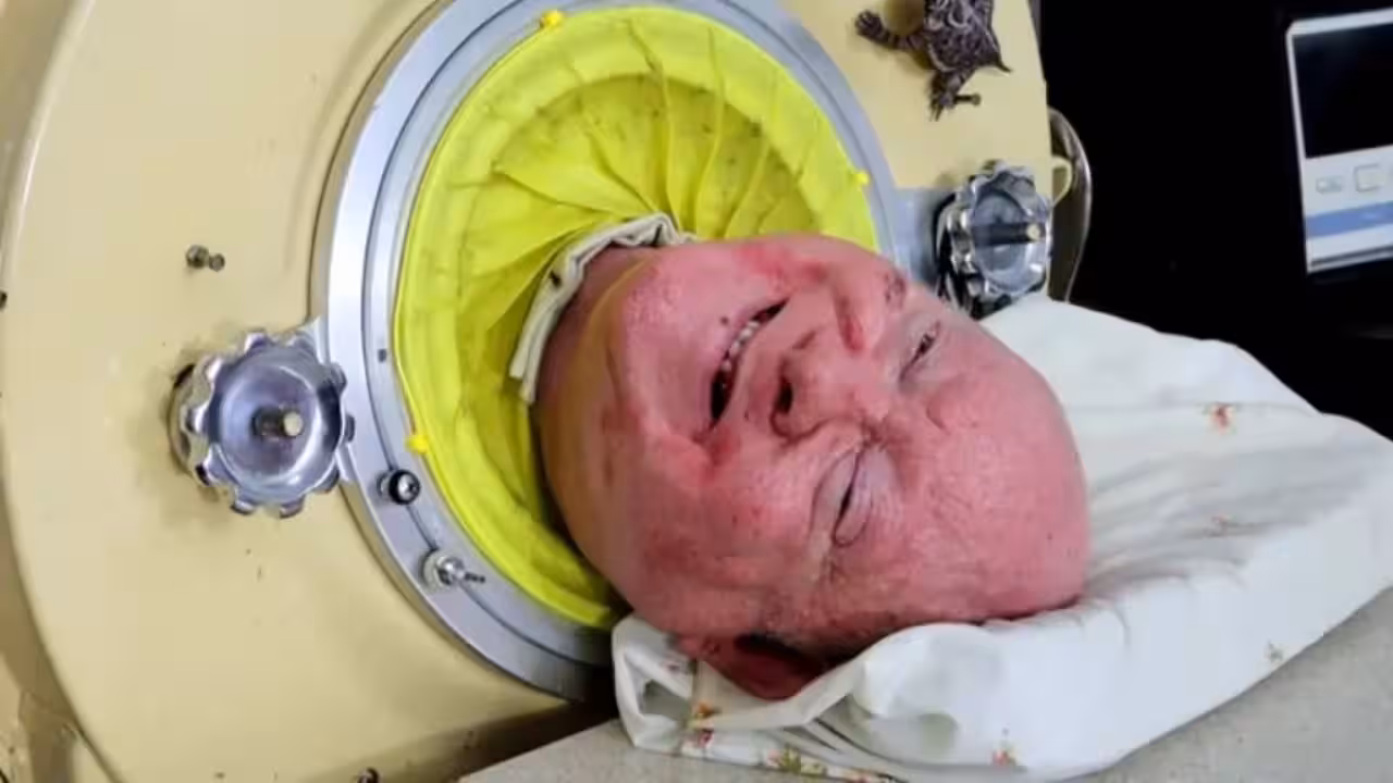 How the iron lung became Paul Alexander's lifeline
